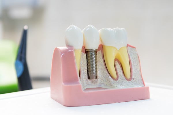 Can A General Dentist Repair A Dental Implant Restoration?