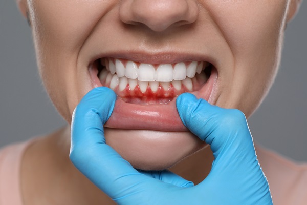 Periodontal Disease: How To Reverse It And Get Healthy Gums Again